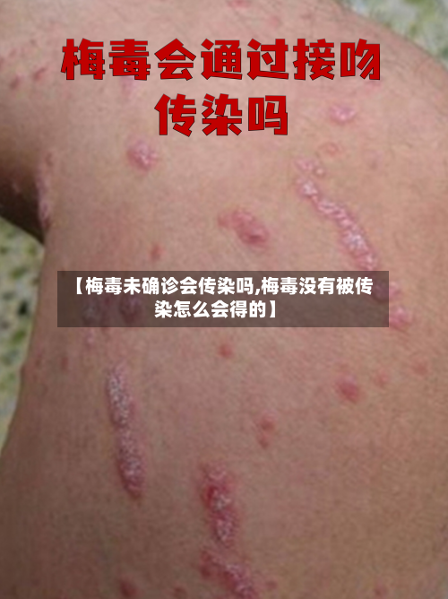 【梅毒未确诊会传染吗,梅毒没有被传染怎么会得的】