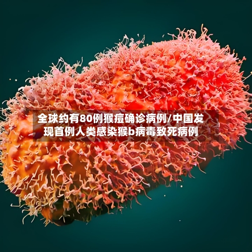 全球约有80例猴痘确诊病例/中国发现首例人类感染猴b病毒致死病例