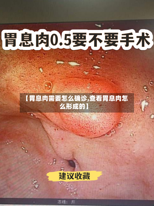 【胃息肉需要怎么确诊,查看胃息肉怎么形成的】