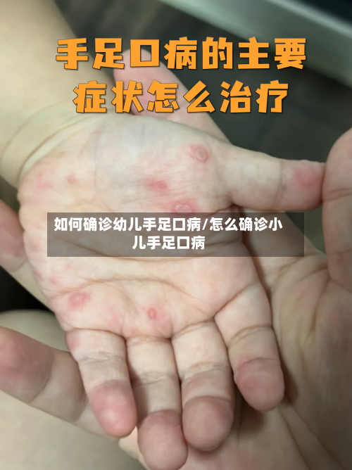 如何确诊幼儿手足口病/怎么确诊小儿手足口病