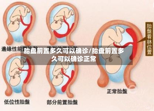 胎盘前置多久可以确诊/胎盘前置多久可以确诊正常