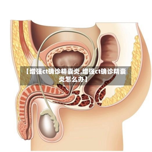 【增强ct确诊精囊炎,增强ct确诊精囊炎怎么办】