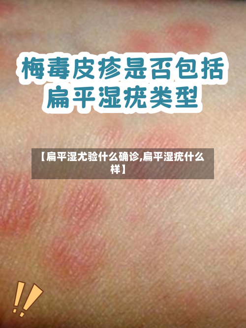 【扁平湿尤验什么确诊,扁平湿疣什么样】
