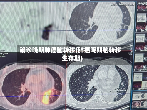 确诊晚期肺癌脑转移(肺癌晚期脑转移生存期)
