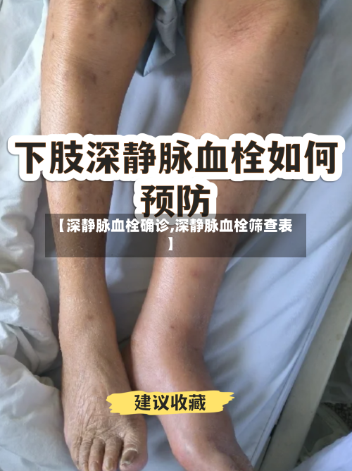 【深静脉血栓确诊,深静脉血栓筛查表】