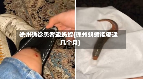 徐州确诊患者逮蚂蝗(徐州蚂蟥能够逮几个月)