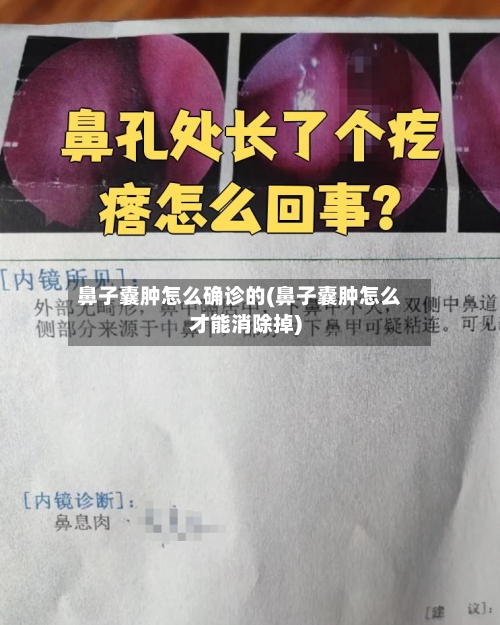 鼻子囊肿怎么确诊的(鼻子囊肿怎么才能消除掉)