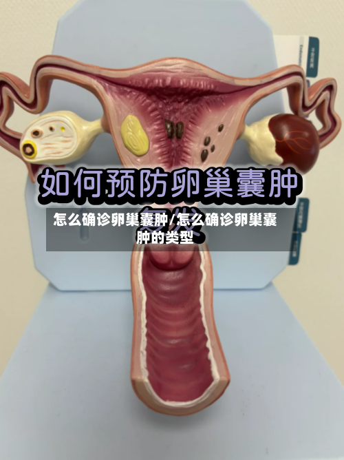 怎么确诊卵巢囊肿/怎么确诊卵巢囊肿的类型