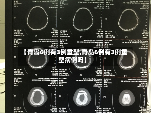 【青岛6例有3例重型,青岛6例有3例重型病例吗】