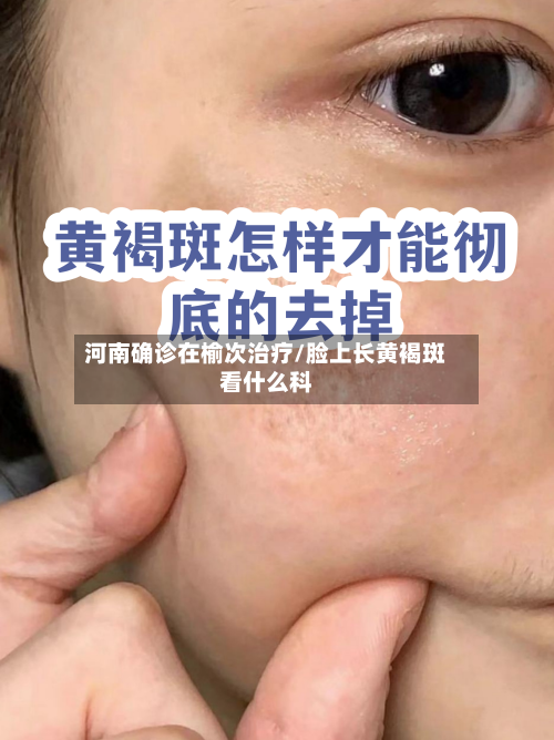 河南确诊在榆次治疗/脸上长黄褐斑看什么科