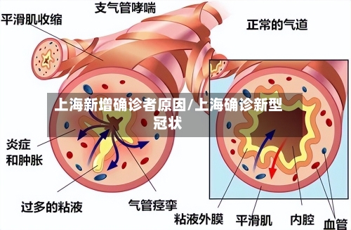 上海新增确诊者原因/上海确诊新型冠状