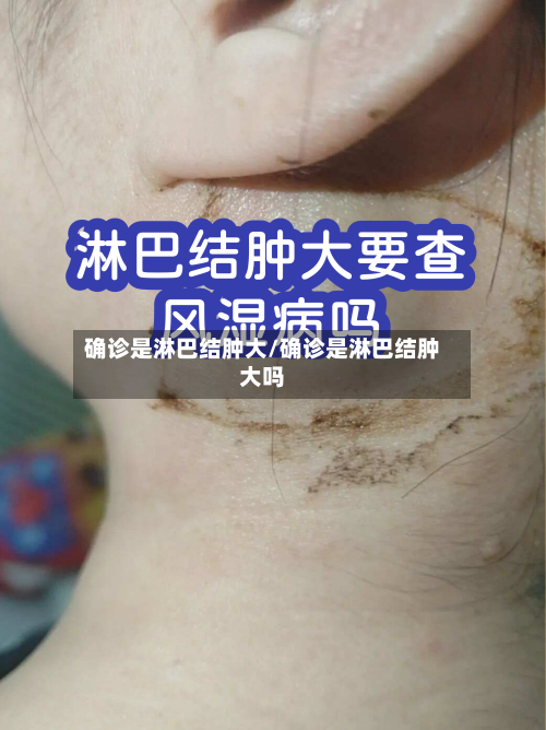 确诊是淋巴结肿大/确诊是淋巴结肿大吗