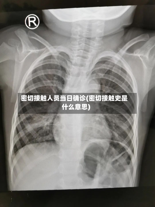 密切接触人员当日确诊(密切接触史是什么意思)