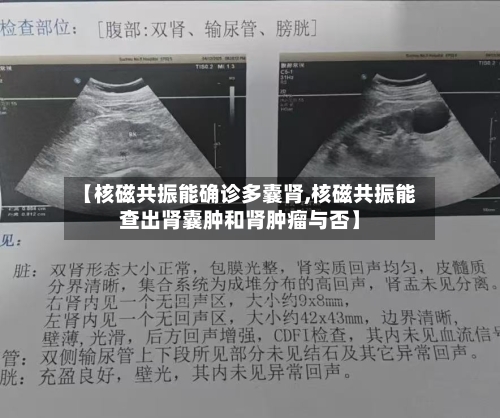【核磁共振能确诊多囊肾,核磁共振能查出肾囊肿和肾肿瘤与否】